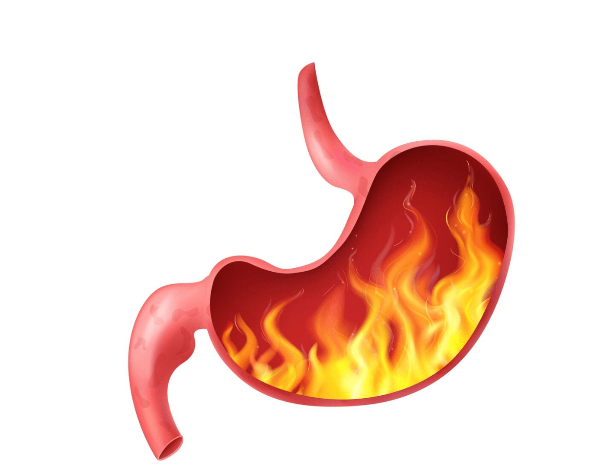 Síntomas de Gastritis Aguda: Guía Completa para Identificarlos y Tratarlos